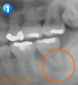 End（歯内療法）セミナー 治療例１ 治療前