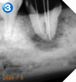 End（歯内療法）セミナー 治療例３ 治療経過