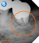 End（歯内療法）セミナー 治療例５ 治療後